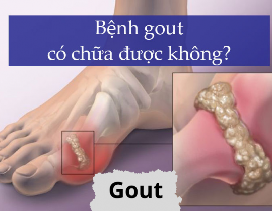 Bệnh gout có chữa được không? Một số lưu ý cần biết về bệnh này