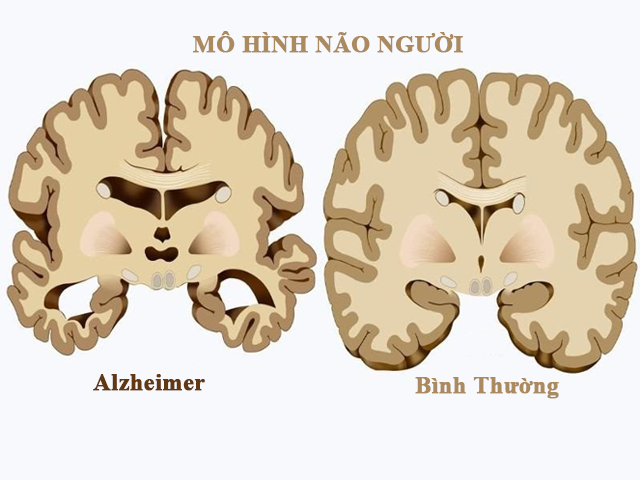 Bệnh Alzheimer có nguy cơ mắc nhiều hơn khi thiếu sắt thiếu máu