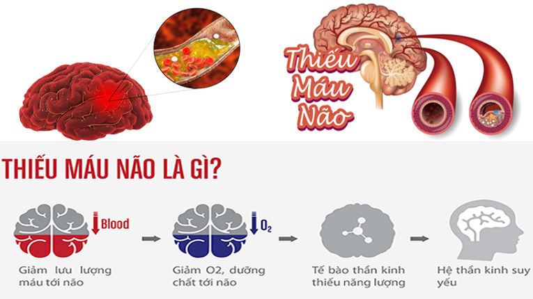 Món ăn cho người thiếu máu não nên ăn là gì