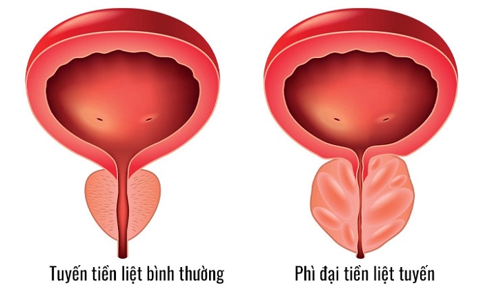 Phì đại tuyến tiền liệt là gì