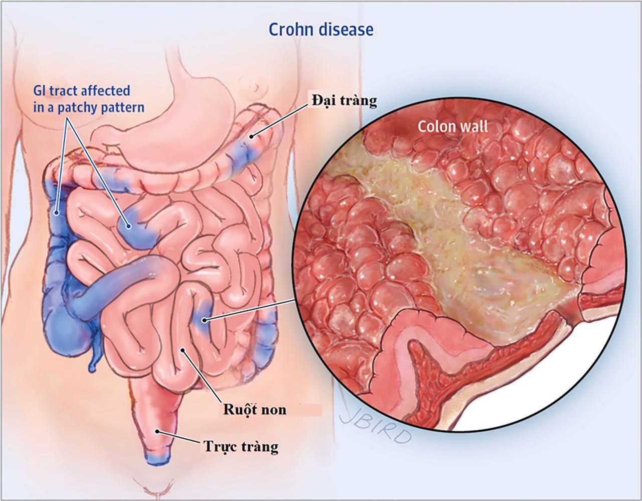 Bệnh Crohn (viêm ruột từng vùng)